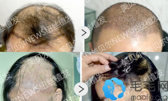 苏州美贝尔植发好不好？头发种植案例+疤痕种植案例来验证